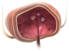 Removal_of_non-invasive_bladder_tumors_with_the_TULA_R__laser_therapy_of_biolitec_R____c__biolitec_R__