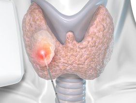 ThyLa_laser_fiber_by_biolitec_R__during_treatment
